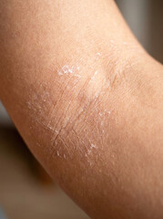 Fototapeta premium Dry skin with visible cracks and peeling on arm, highlighting skin barrier issues