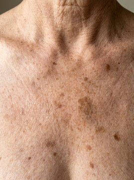 Sun damage freckle on skin with visible pigmentation and texture