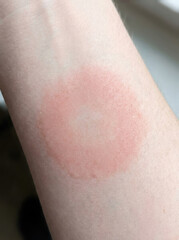 Fototapeta premium Heat flush reaction skin shows circular area with light pink hue. This visual indicates response