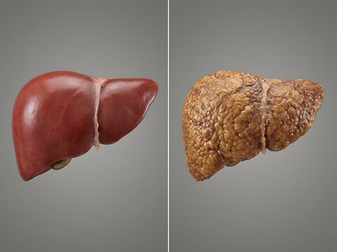 Healthy liver versus cirrhotic liver medical comparison with liver failure