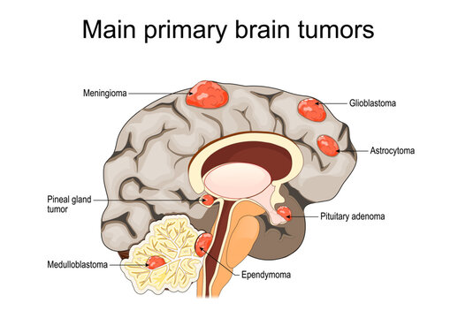 Main primary brain tumors. brain cancer.