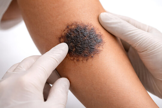 Gloved doctor examining dark scabbed skin lesion on patient arm in clinical dermatology consultation