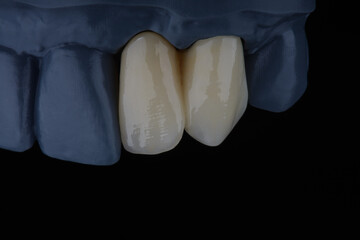 High-quality naturally dental single crowns made of zirconium for fixation to the frontal teeth of upper jaw. © gorynvd