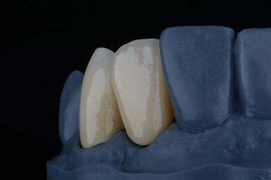 High-quality naturally dental single crowns made of zirconium for fixation to the frontal teeth of upper jaw.