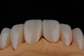 High-quality dental crowns made of zirconium for fixation to the teeth of upper jaw. © gorynvd