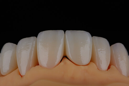 High-quality dental crowns made of zirconium for fixation to the teeth of upper jaw.