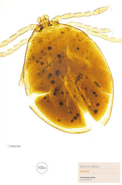 Hard ticks are parasites that attach to a host; their bites are painless, and they can transmit bacterial, protozoal, and viral diseases such as Lyme disease, encephalitis, and tularemia.
