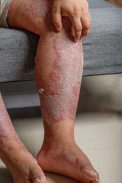 Close-up of inflamed dry scaly skin on a human leg, A chronic skin condition with redness, irritation, and flaky texture for healthcare and dermatology
