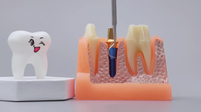 dental probe pointing to a dental implant, gum tissue, jawbone and tooth roots on an anatomical model.