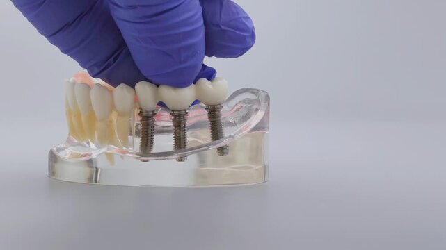 Dentist hand in blue glove placing dental bridge on implant jaw model. Dental prosthetics concept with copy space