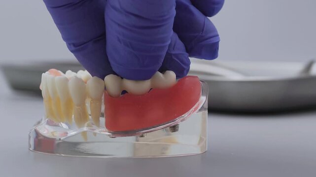 Dentist hand in blue glove placing dental bridge onto implant jaw model. Clinical prosthetics concept