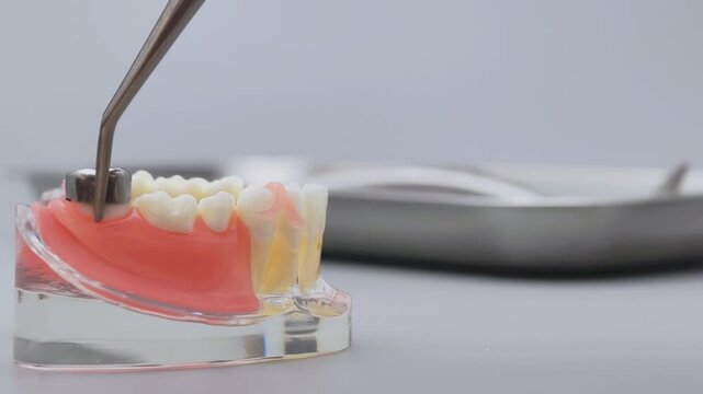 Metal Dental Crown Placement on Molar Tooth Model