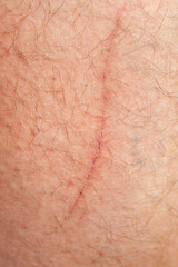 Fototapeta premium Close-up of human skin with faint red linear scar