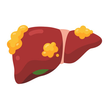 Cartoon depiction of a diseased human liver showing unhealthy yellow fat deposits indicating a serious medical condition