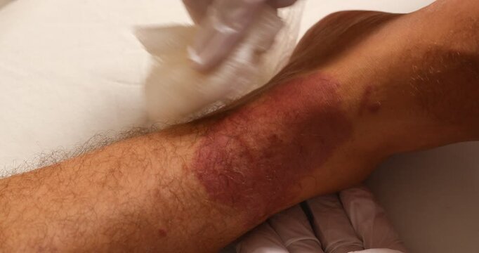 Close-up shot of a medical professional wearing latex gloves treating a patient's leg. The patient has a severe, large red skin lesion, which could be the result of a severe allergic reaction