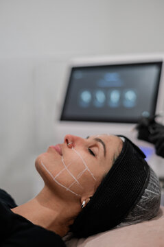 Close up of clients face with facial mapping receiving a skin treatment in a clinic