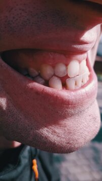 Close-up view reveals a man mouth with misaligned yellow teeth and prominent gaps between the lower incisors. Concept of dental health, orthodontic care, malocclusion, and poor oral hygiene.
