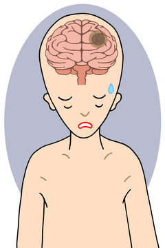 脳の疾患のイラスト - 脳腫瘍・頭蓋内新生物・脳疾患