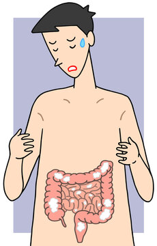 病気・疾患・疾病のイラスト - クローン病・炎症性腸疾患・潰瘍