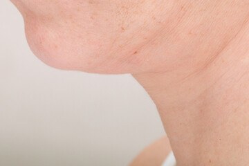 Fototapeta premium Closeup of Submental Region with Natural Skin Texture and Freckles