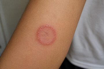 Fototapeta premium Close-up of a red circular ringworm fungal infection on human skin