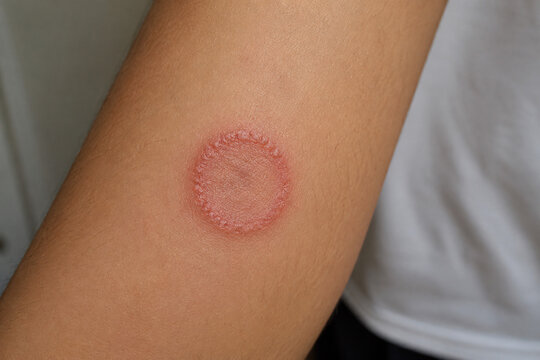 Close-up of a red circular ringworm fungal infection on human skin