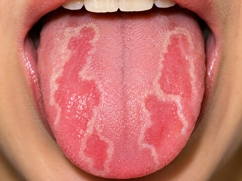 Closeup of a tongue showing signs of geographic tongue condition