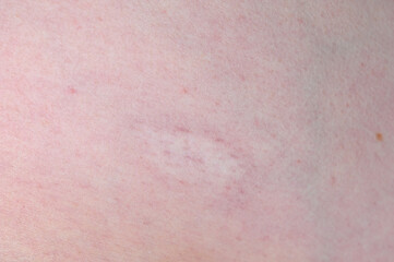 Fototapeta premium Close-up of fair skin showing visible capillaries, small red spots and fine skin texture