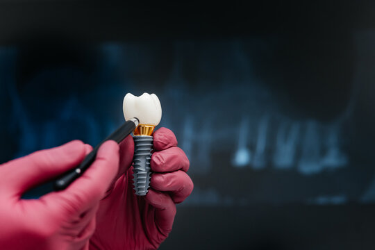 Modern dental implant with ceramic crown presented before panoramic X-ray image for dental treatment planning, implant placement and restorative dentistry