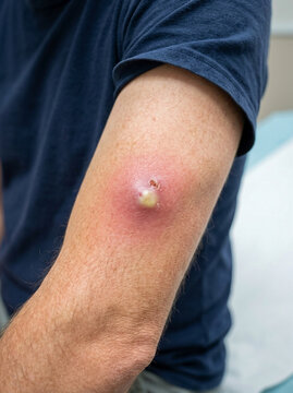 Large painful skin abscess with visible pus on a human arm