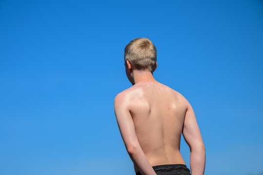 Sunburned boy standing under clear blue summer sky.