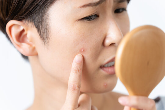 顔のにきびに悩む女性