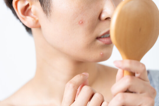 顔のにきびに悩む女性