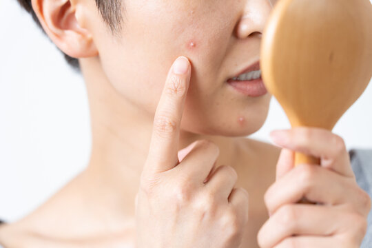 顔のにきびに悩む女性