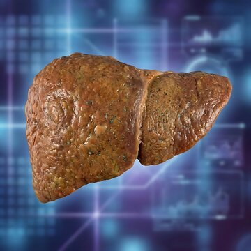A full human liver organ showing uniform enlargement, pale color, and signs of fatty infiltration (steatosis), symbolizing Non-Alcoholic Fatty Liver Disease (NAFLD), in a misty, ethereal digital paint