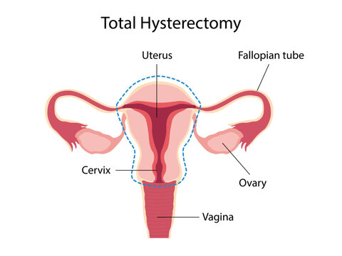 Total hysterectomy. Female reproductive anatomy. Gynecological surgery diagram for anatomy education, medical, healthcare presentations, clinical resources. Vector Medical educational illustration

