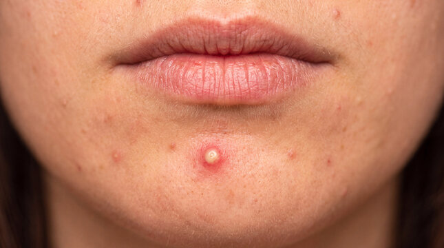 Acne pimple chin skin face blemish closeup view lower face with acne pimple on chin, facial skin with blemish and inflammation