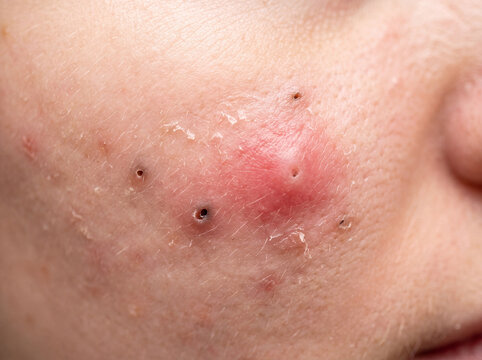 Acne pimple skin face blackhead inflammation Closeup facial acne with red pimple, blackhead, irritation, and peeling skin