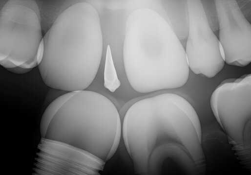 Dental xray showing a supernumerary tooth between central incisors