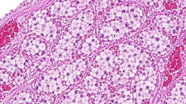 Clear Cell Renal Cell Carcinoma Histopathology H&E Stained Microscopic Tissue Illustration