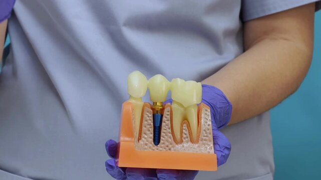 Professional dentist in protective gloves holding an anatomical jaw model and demonstrating a dental bridge placement over an implant abutment.