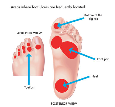 Medical illustration of areas where foot ulcers are frequently located.