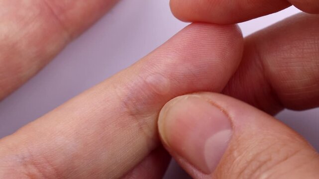 Typical skin burn blister on the finger from second-degree boiling oil burns close up