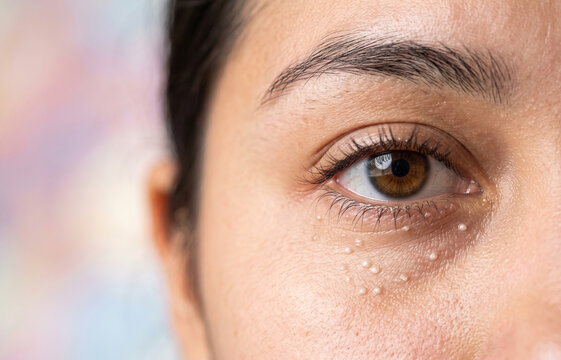 Close up of white milia bumps under the eye of a woman, milk spots skin condition and facial dermatology