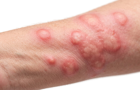 Macro close up of severe hives allergic reaction and red itchy welts on human arm, dermatology concept.