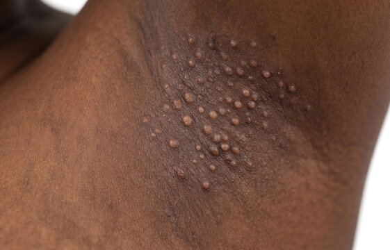 Close up of multiple skin tags acrochordon and bumps on dark skin armpit of human body.