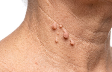 Fototapeta premium Multiple skin tags acrochordon on senior female neck close up