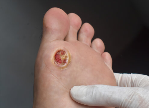 Diabetic Foot Ulcer Examination by Medical Professional
