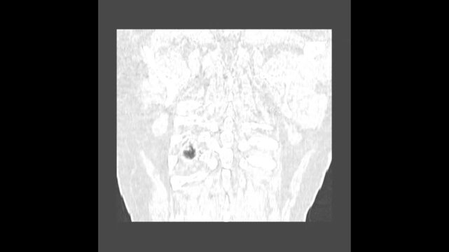 Coronal Multiplanar Reconstruction HRCT Chest Scan Showing Bilateral Lung Fields for Medical Education