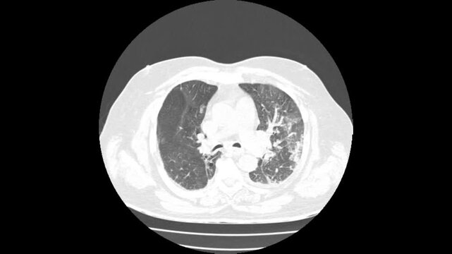Coronal HRCT Scan View of Thorax Showing Lungs Bronchovascular Tree Mediastinum and Diaphragm